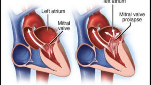 What Is Mitral Valve Regurgitation Symptoms Causes And Treatmenttreatment Dr Atul Kasliwal S