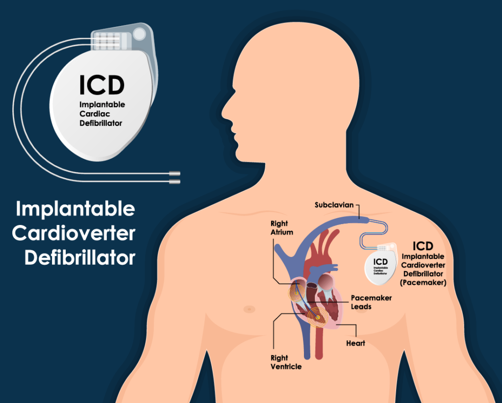 what-is-a-pacemaker-dr-atul-kasliwal-s-blog-cardiology-heart