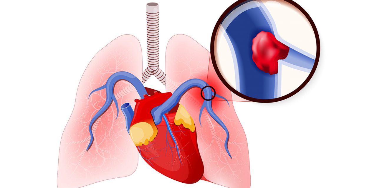 Anal Thrombosis - What Is Pulmonary Embolism â€“ Symptoms, Treatment And Recovery | Dr Atul  Kasliwal's Blog â€“ Cardiology, Heart Doctor, Cardiac Specialist
