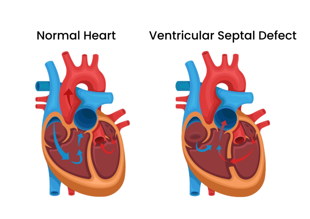 Ventricular Septal Defects (VSD) Dr Atul Kasliwal's Blog - Cardiology ...